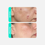 DuoGel 7% Acido Mandélico +Tônico Salicílico